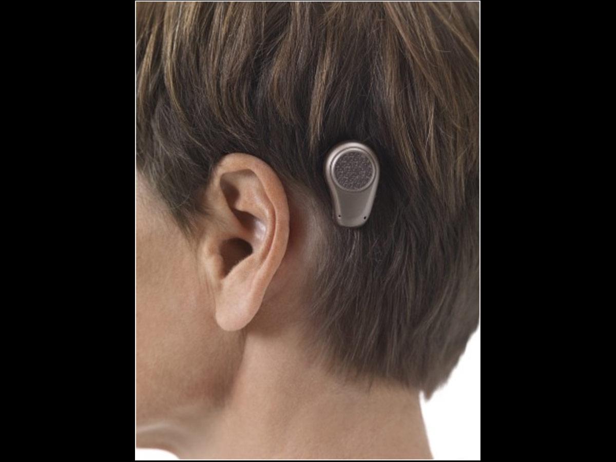 Bone Anchored Hearing Aids (From Wikipedia)