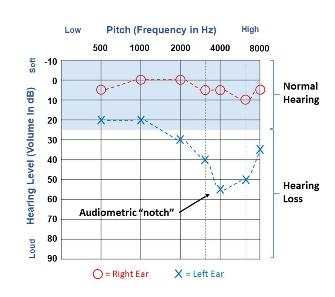 Sample audiogram (From: Wikimedia Commons).