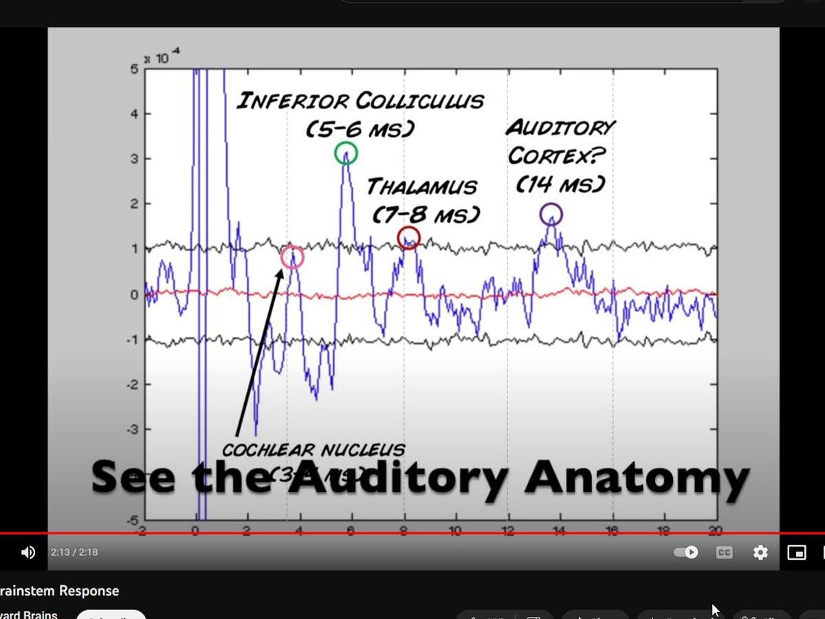 A computer records your brain activity on an audiogram. (From: YouTube/Backyard Brains)