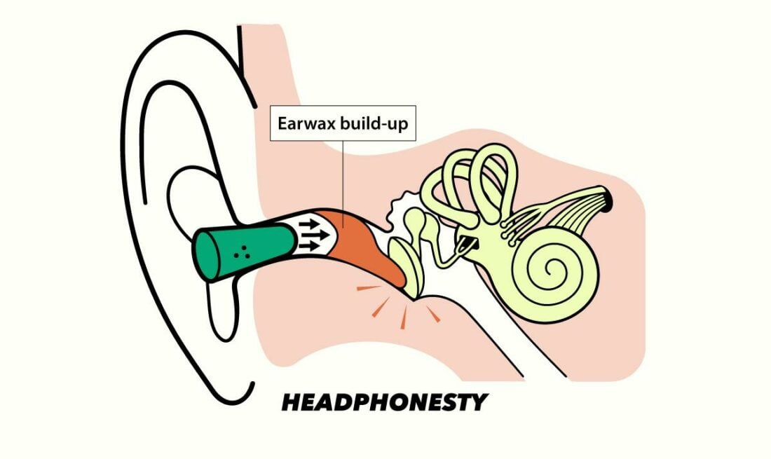 How earplugs cause earwax build-up