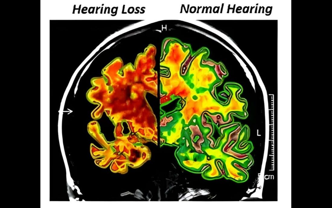 Brain scans of someone with hearing loss vs someone with normal hearing showing decrease of gray matter on the former. (From: HearingHealthCenter)