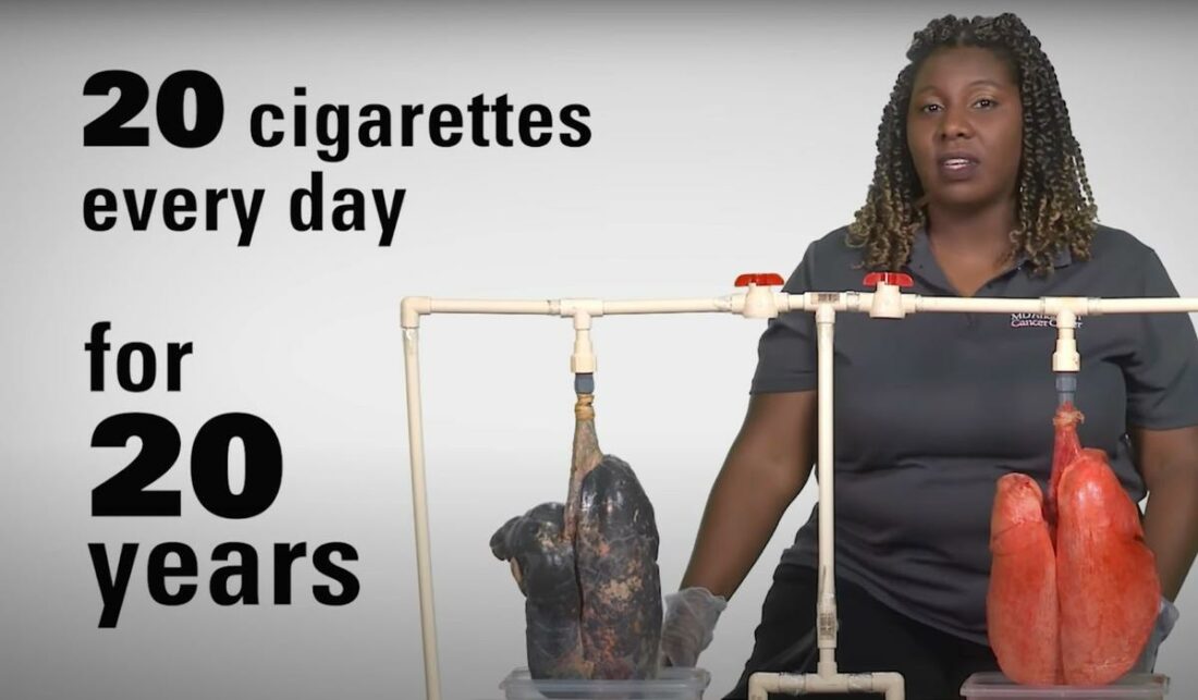 How the lungs of a smoker differs from a non-smoker's lungs. (From: YouTube/ MD Anderson Cancer Center)